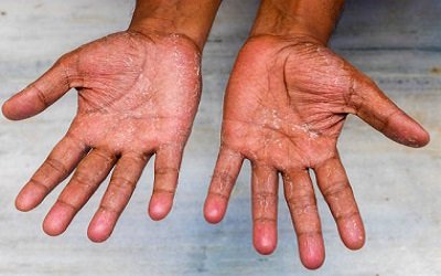 How to treat your Peeling hands and make them new again